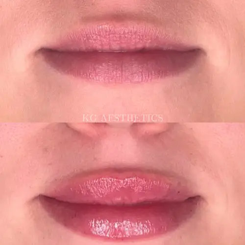 Fillers before and after the result in the Lips by The Aesthetic District