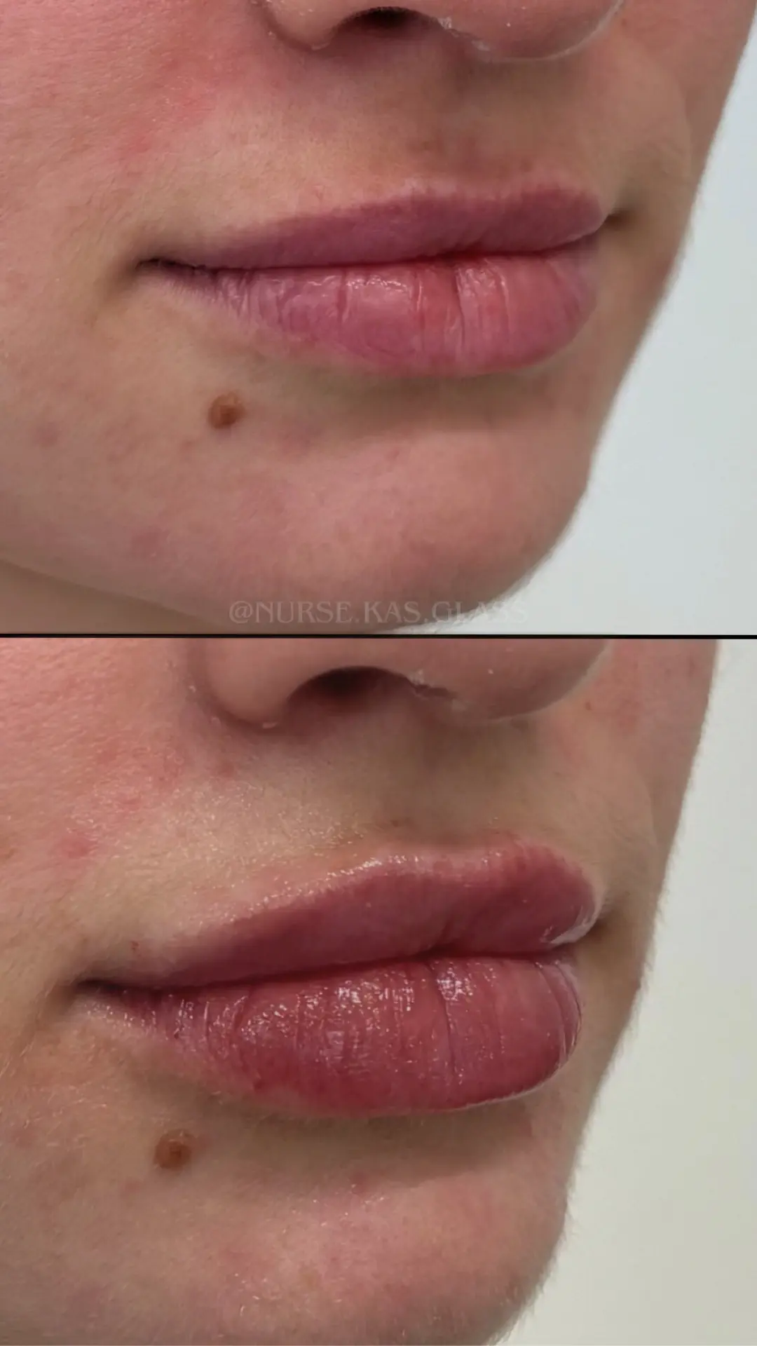 Lip filler before and after for fuller shape result