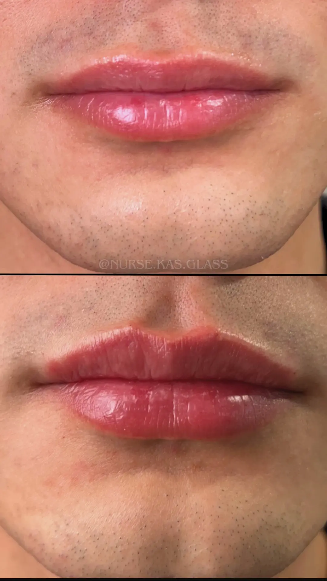 Chin and lips before and after subtle filler boost