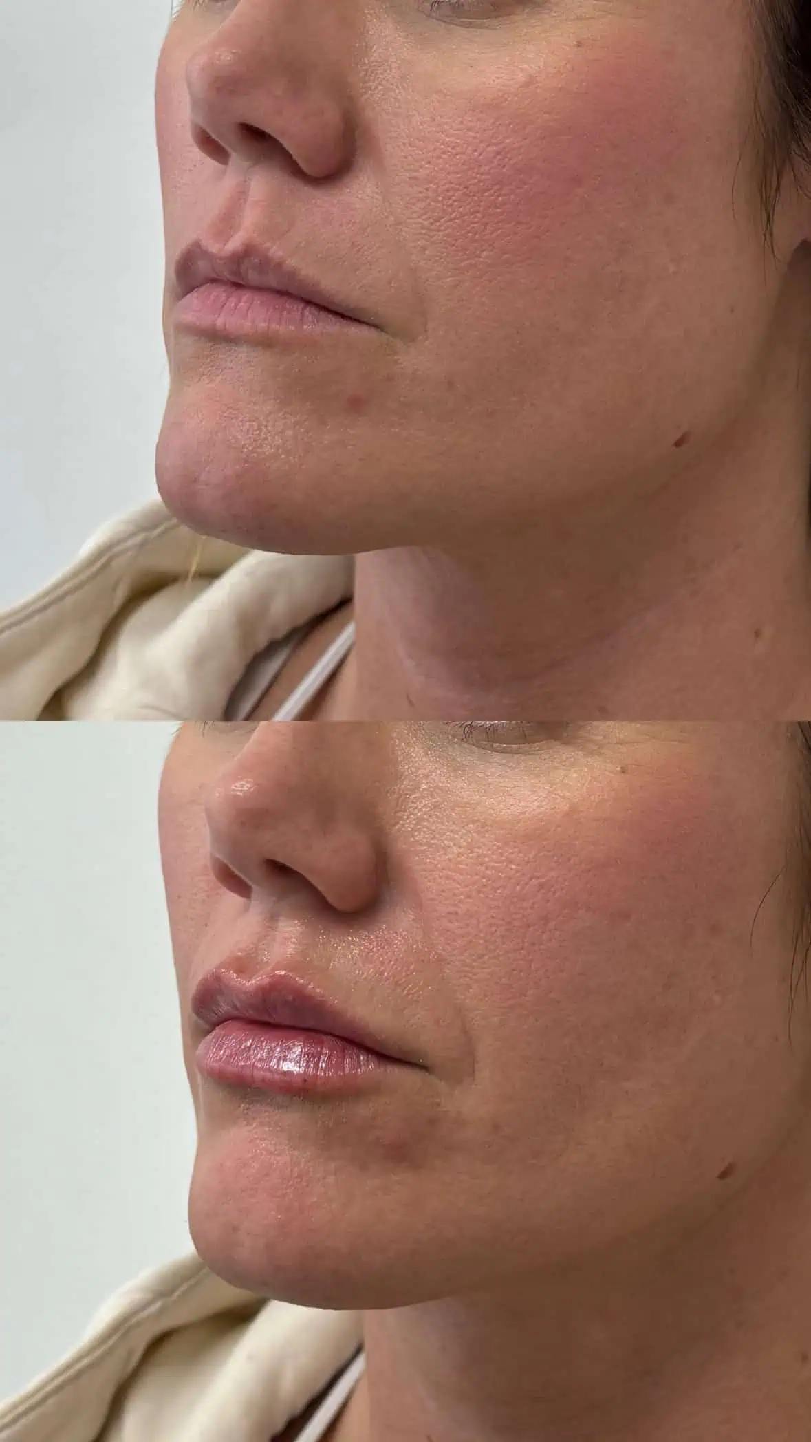 Fuller, hydrated lips after filler enhancement