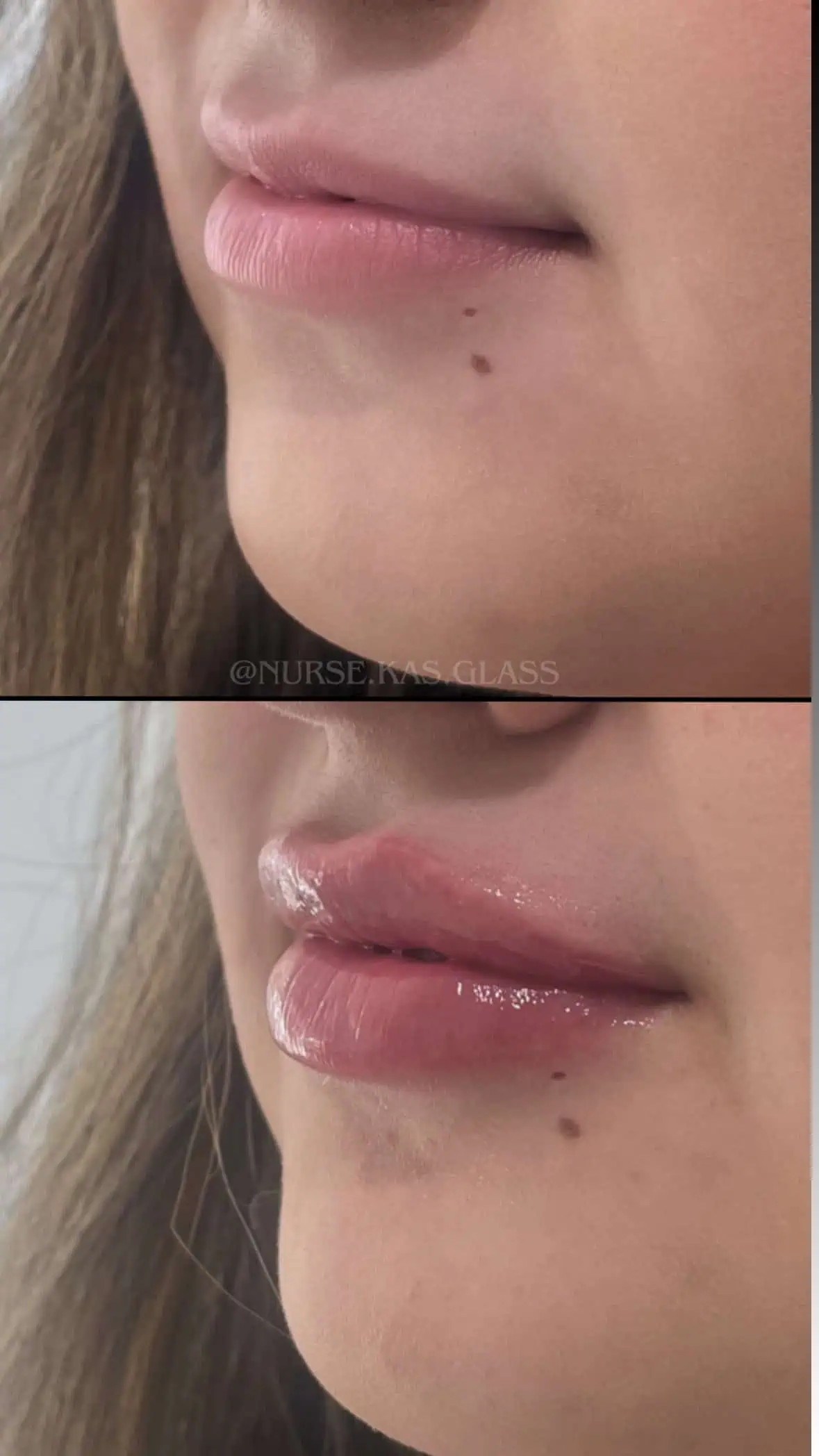 Before and after lip filler showing subtle volume