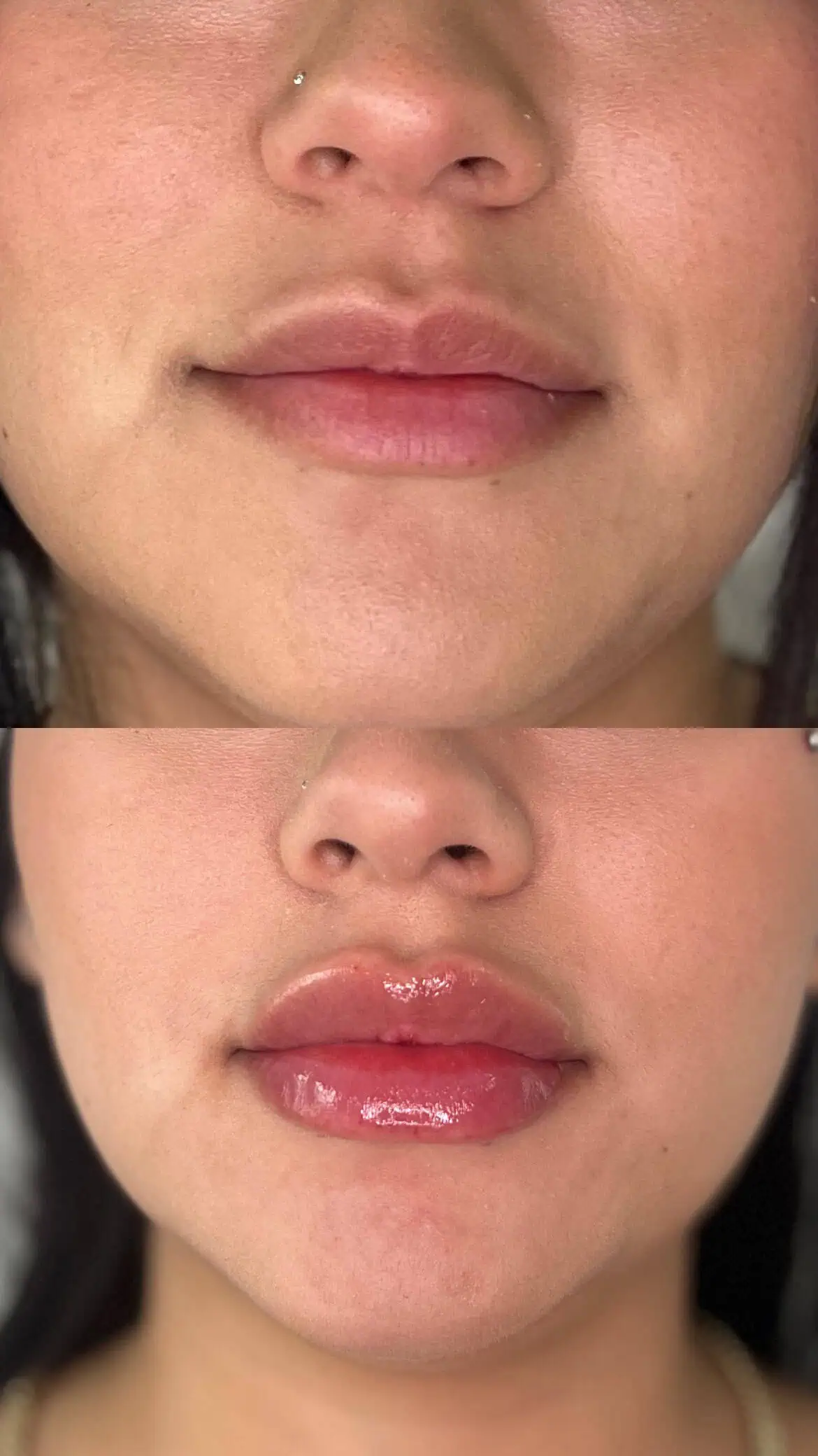 Natural lip filler result enhancing shape and contour