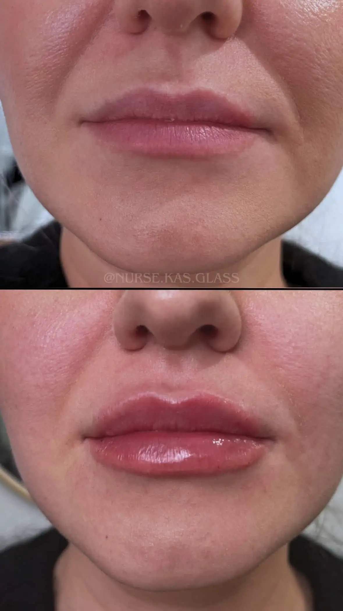 Lip filler transformation for balanced, fuller look