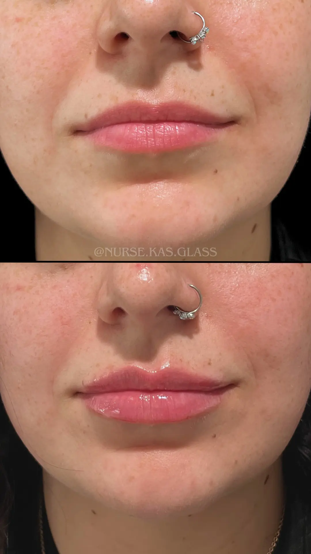 Natural lip filler enhancement with soft definition