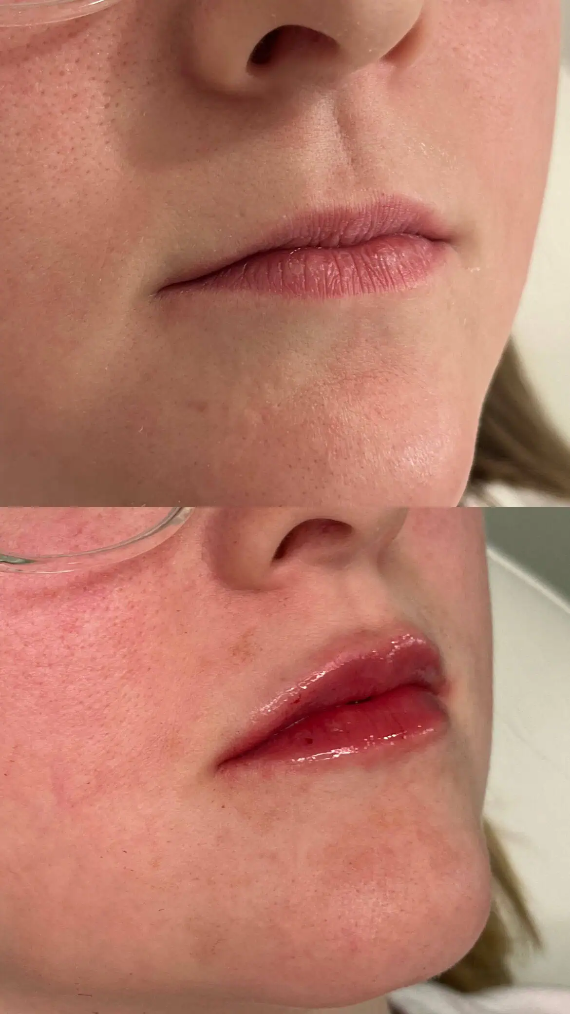 Defined lip shape and contour post-filler treatment