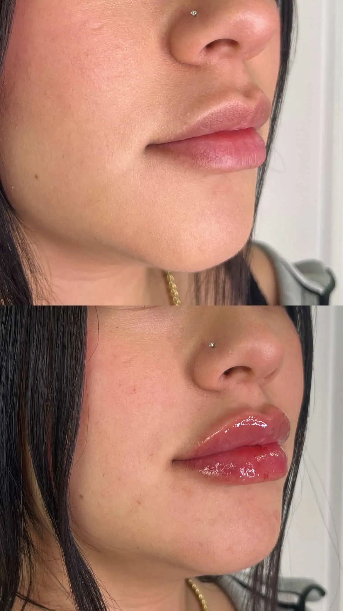 Lip filler providing balanced fullness and symmetry