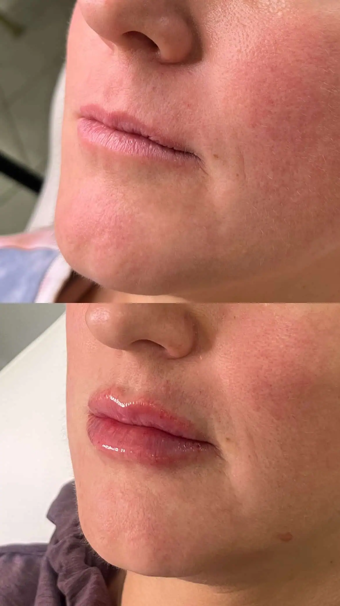 Glossy lips after filler treatment with a smooth finish
