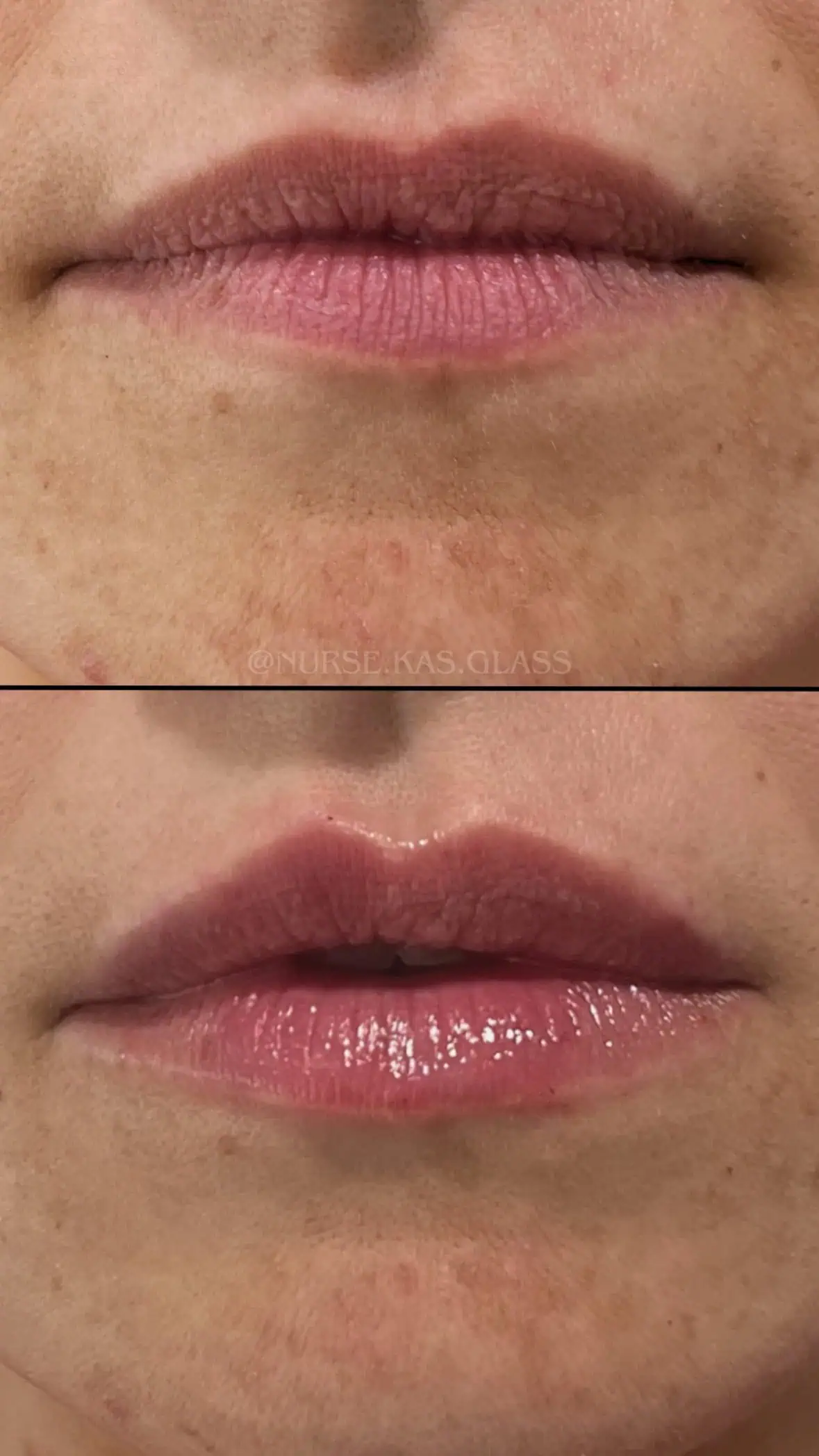 Lip volume increase after hyaluronic filler session