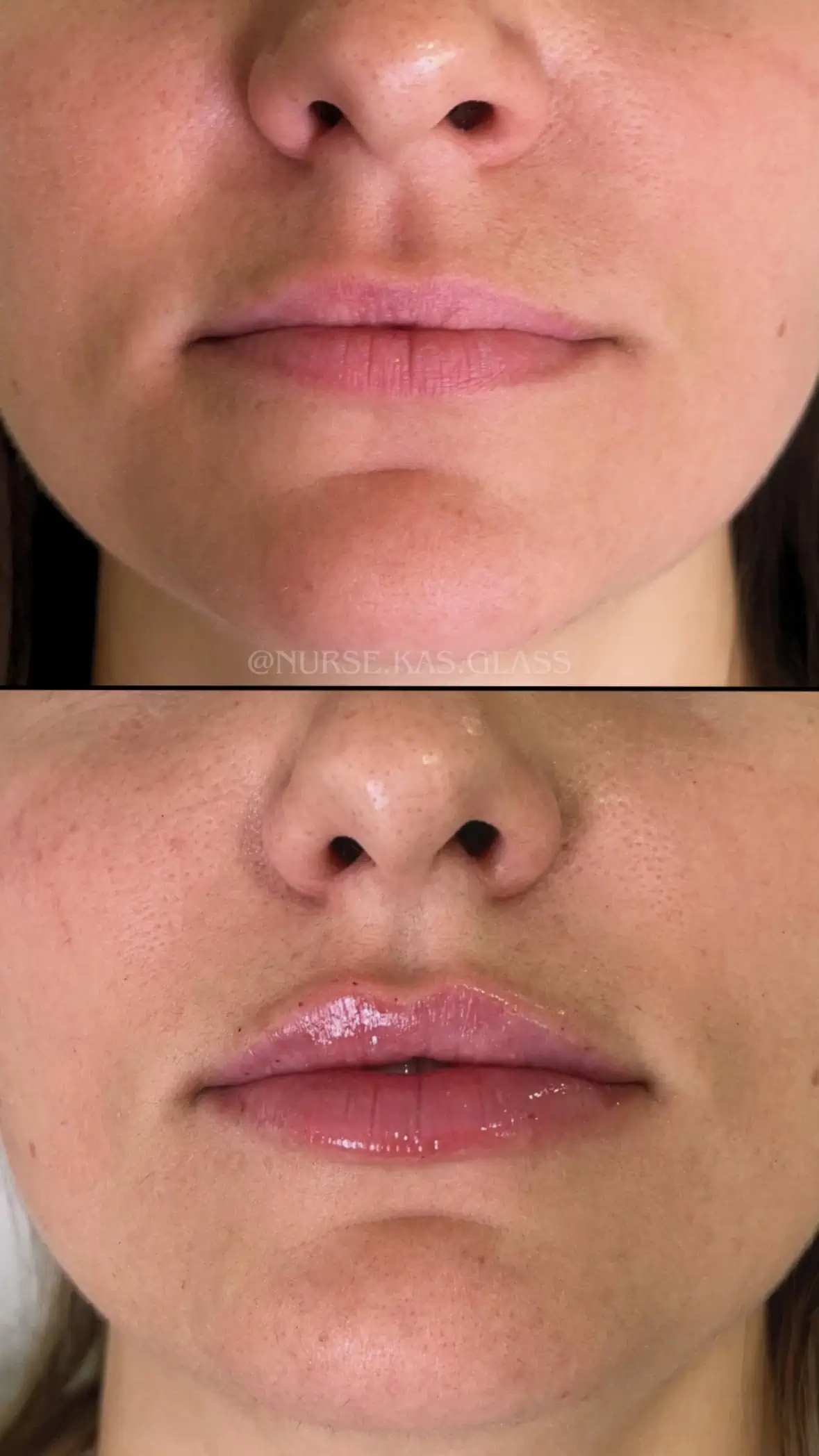 Natural result from lip filler enhancement procedure