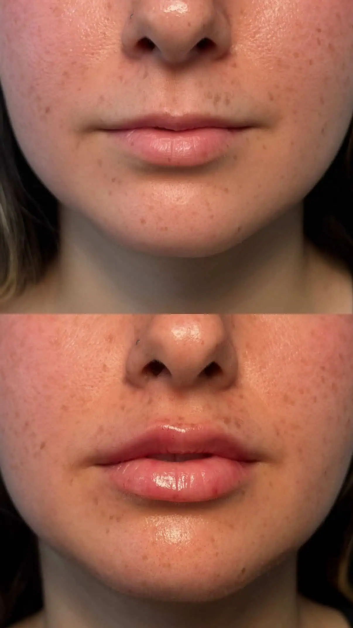 Natural enhancement of lips with visible volume gain