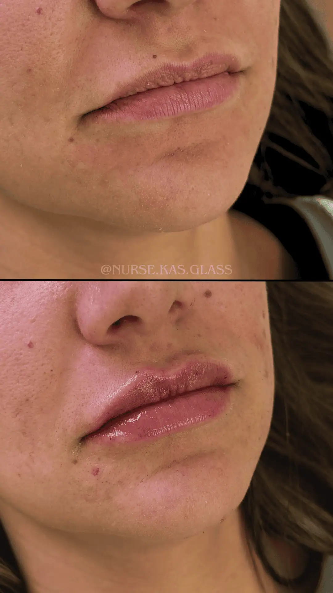 Natural plump lips post aesthetic filler treatment