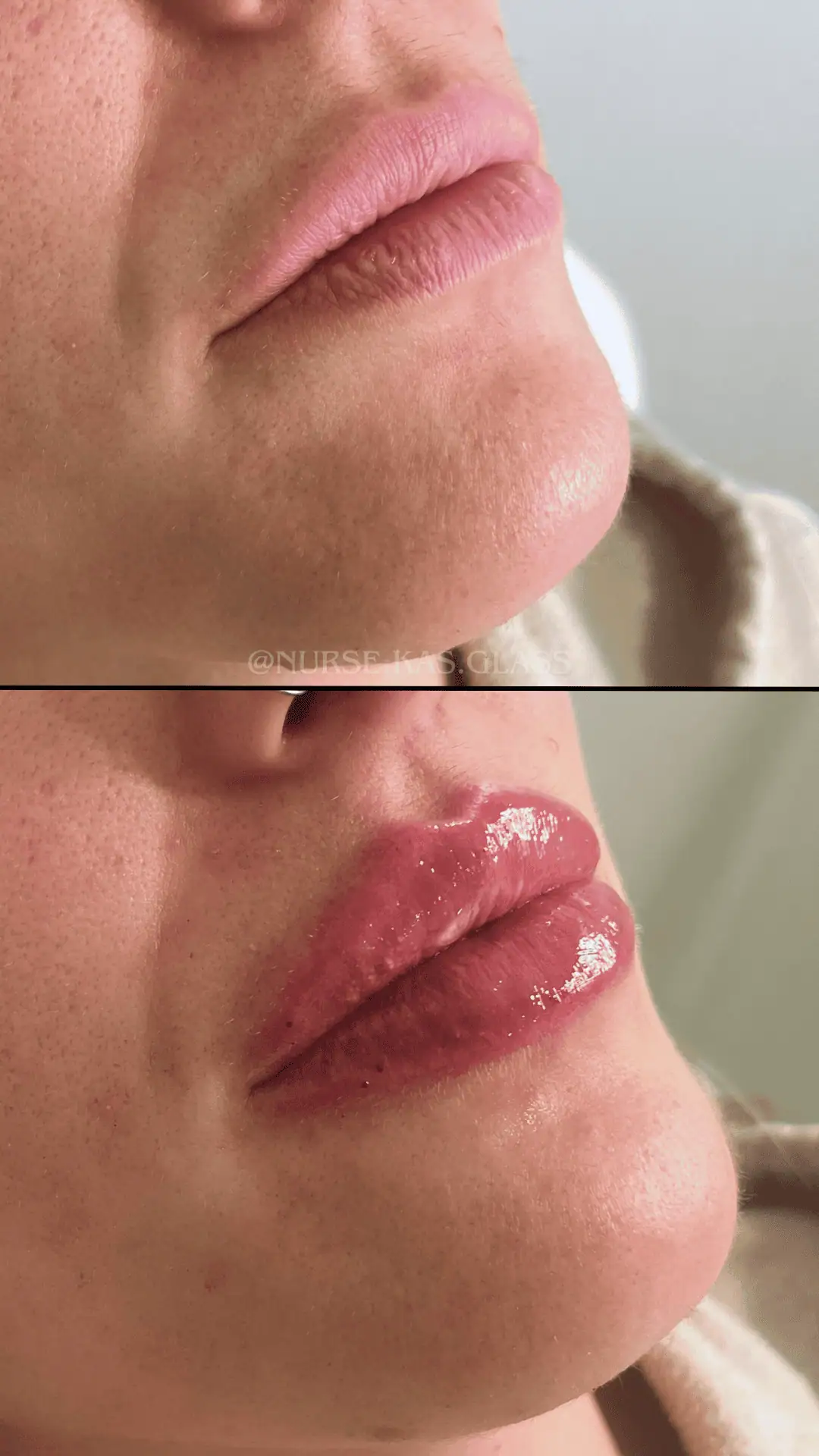 Lip filler before and after showing symmetry results