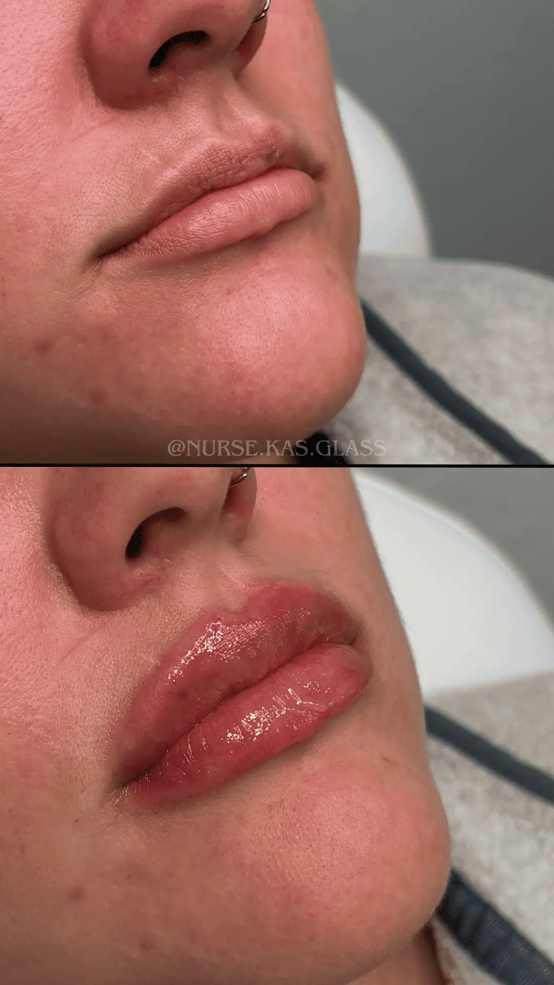Lip filler treatment with a soft, glossy finish result