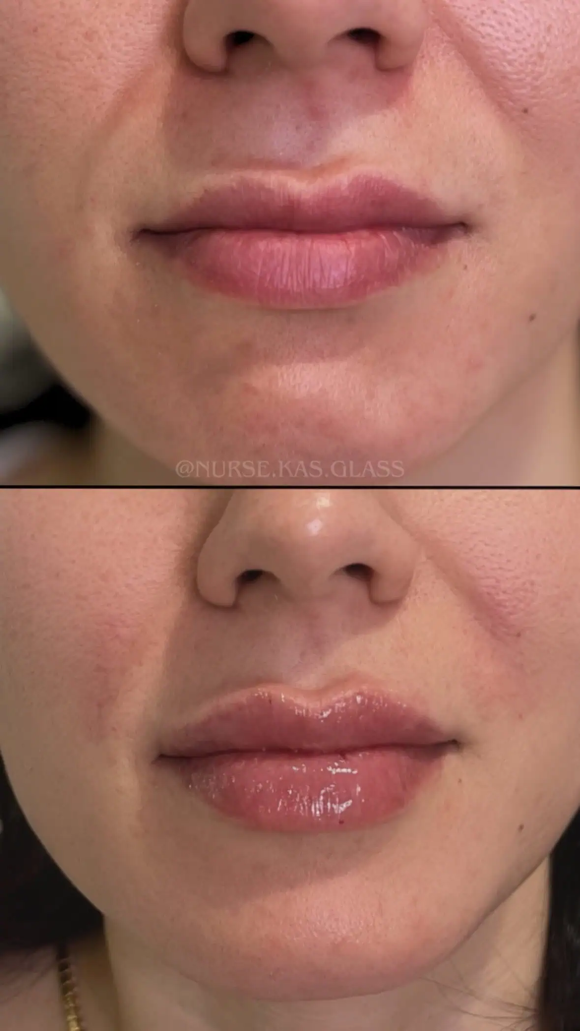 Enhanced lip projection with natural filler results