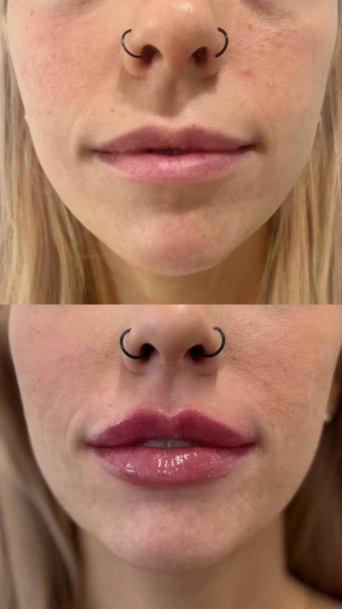 Close-up of lips showing natural filler enhancement