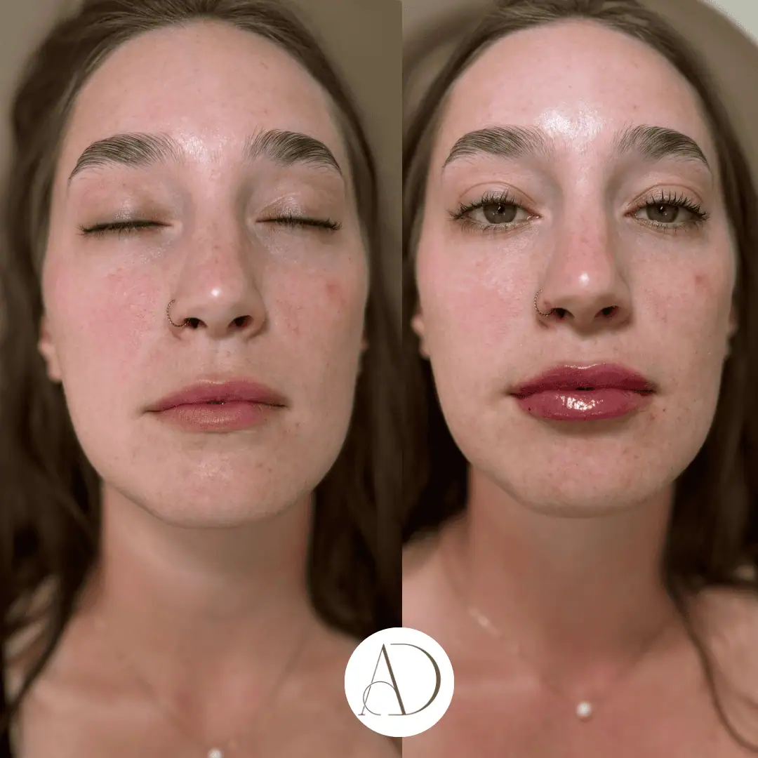 Close-up of lips before and after subtle enhancement